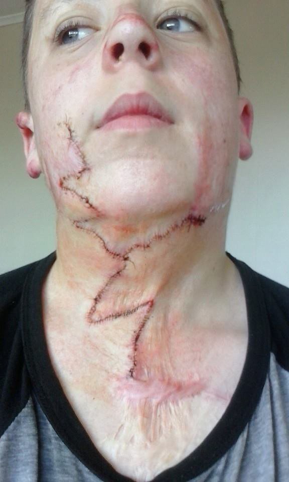 A healing scar after an operation in 2015 to help increase movement in his neck.