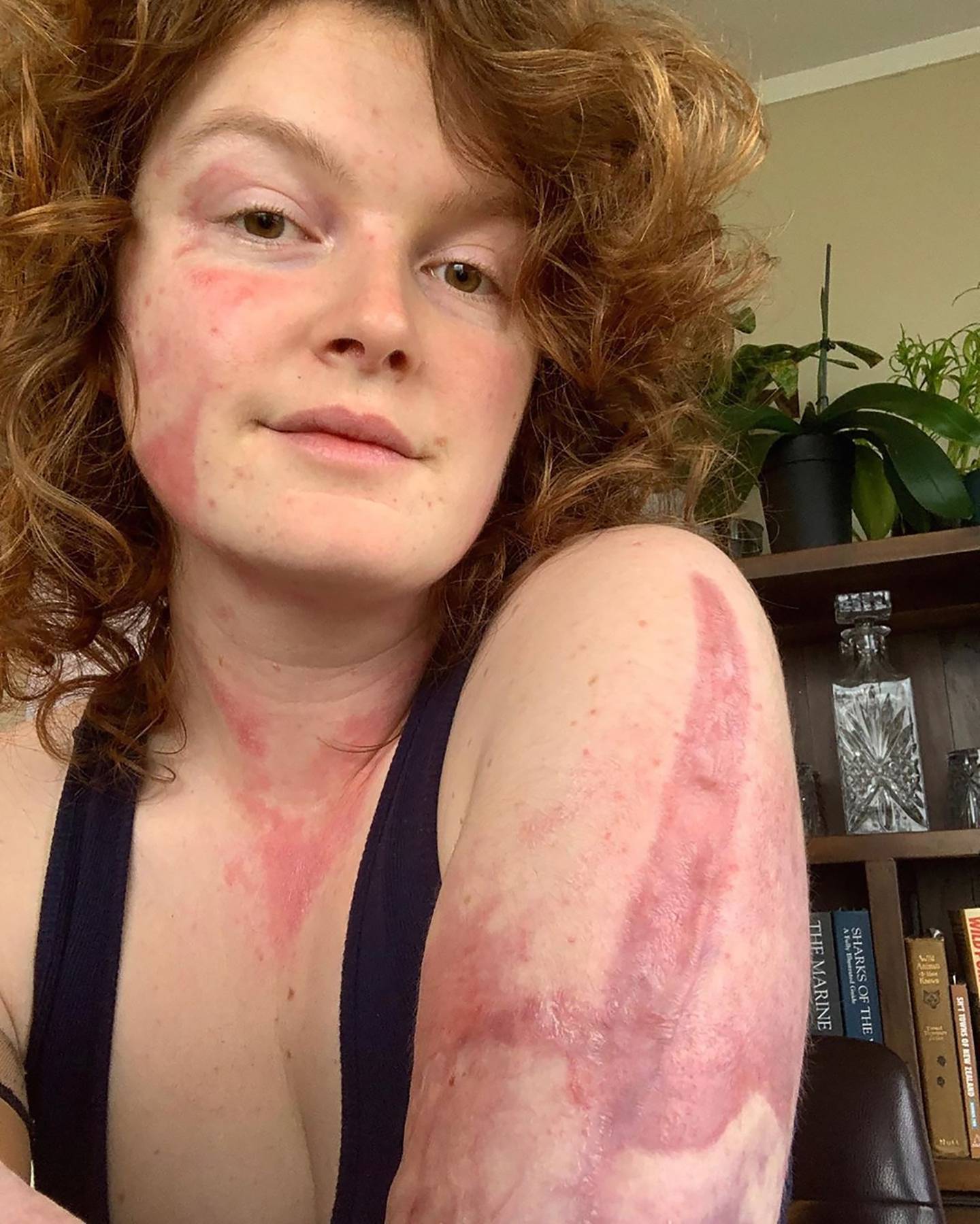 Kelsey Waghorn, survivor from the Whakaari White Island volcanic eruption from 10 December 2019,...