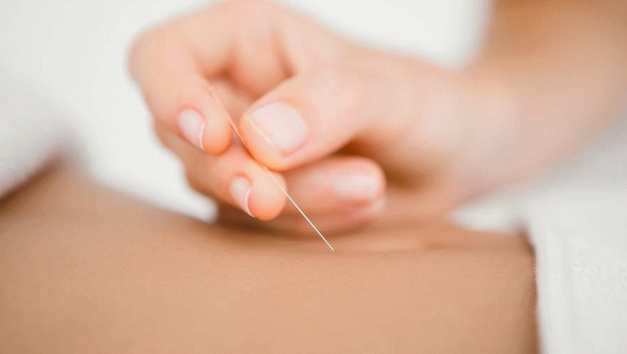 A woman's lung collapsed when a physiotherapist performed acupuncture on her. Photo: NZ Herald