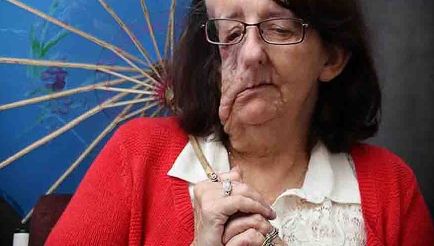 Christine Brown was born with neurofibromatosis and had multiple tumours grow on her face. Photo ...