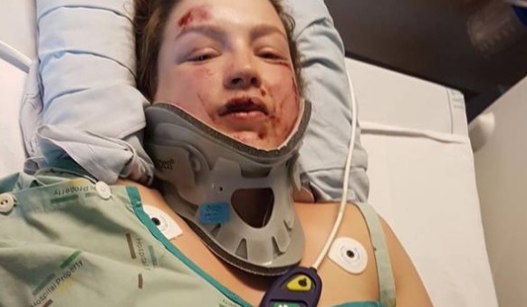 Amy Gianfrancesco fractured her C7 vertebrae, at the base of her neck. Photos: NZ Herald