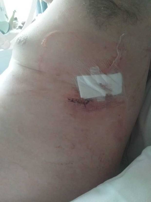 Jamie Cunningham got a stingray barb to his chest at Oreti Beach on Saturday. Photo: Supplied