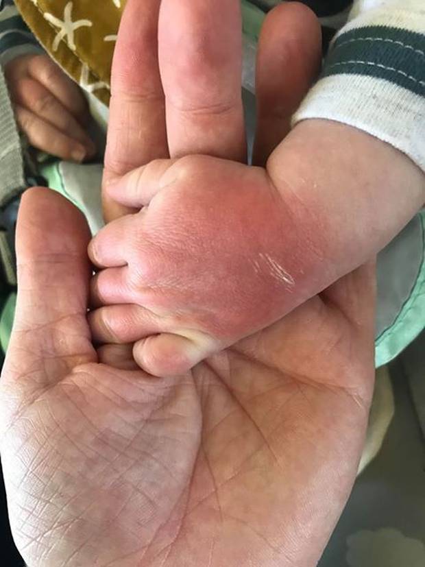 Noah's wee hands four days after getting burnt. Photo: Supplied