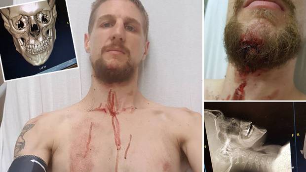 Liam Thompson, 27, went over the handlebars of a Lime scooter. Photos : Supplied