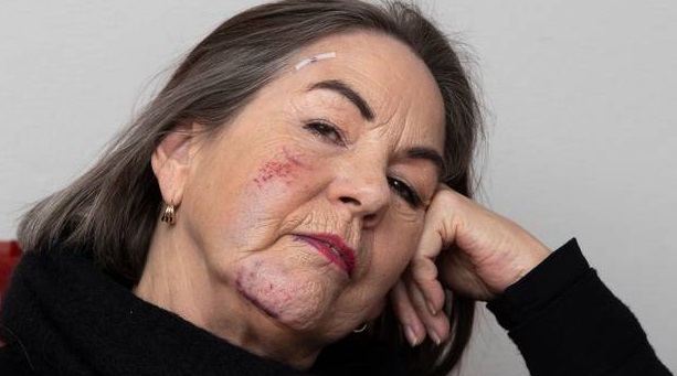 Debra Christensen was hit and knocked out by a Lime scooter as she was getting off a bus near...