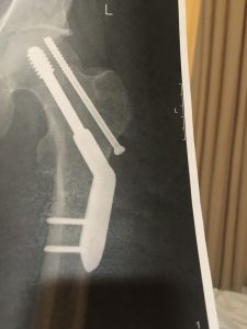 A‘‘freak accident’’ at Coronet Peak on July 25 left Carlton Johnstone with two large metal rods...