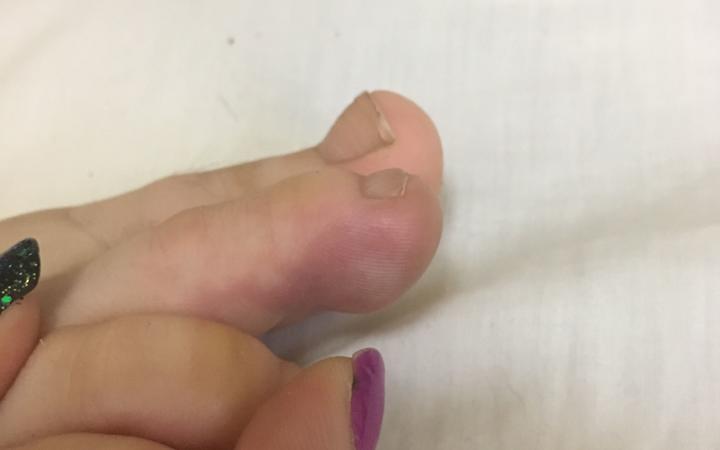 Suzanne Insley's problems began with a sore toe two years ago. Photo: Supplied via RNZ