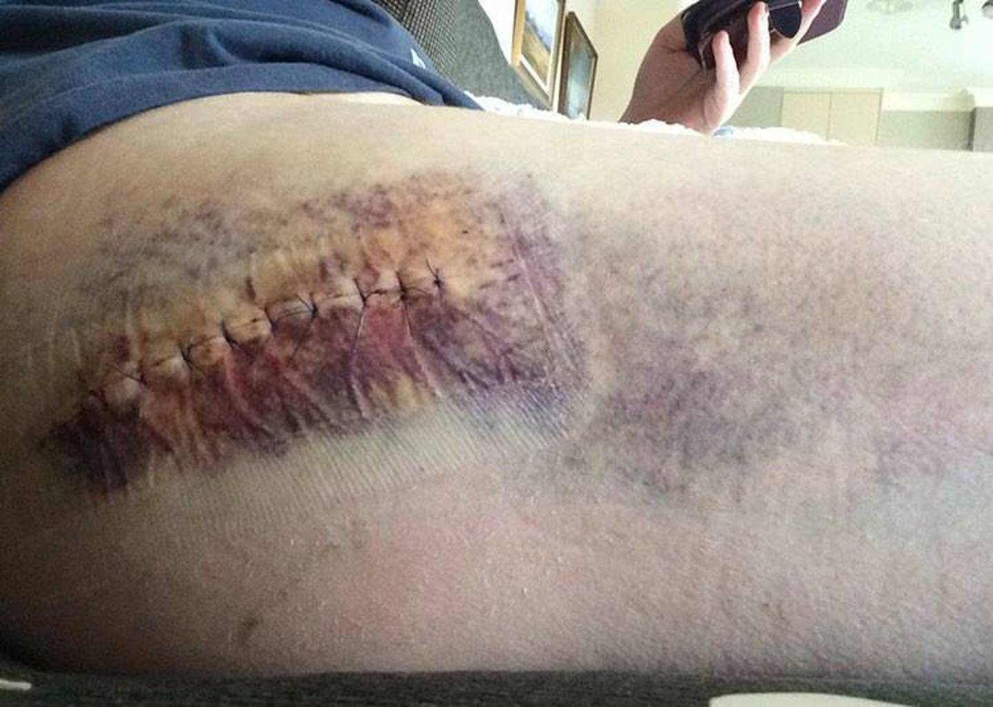 Philippa Hyndman's thigh was bruised and she had to undergo surgery following a hit-and-run in...