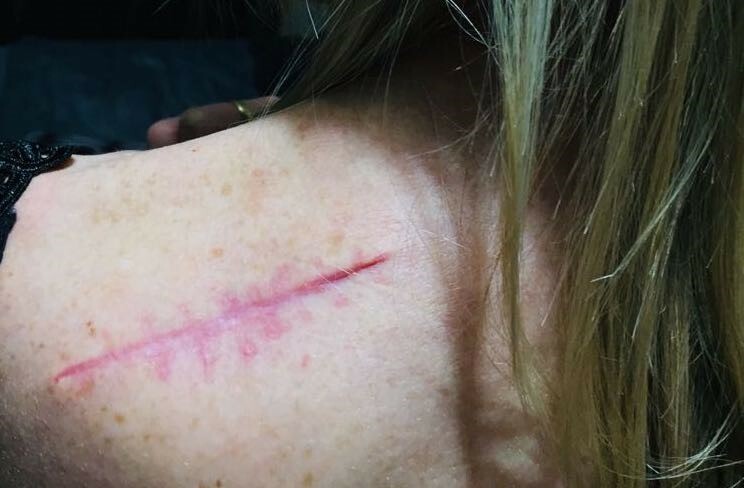 The scar from Wendy’s first wide local inci­sion surgery, which unfor­tu­nate­ly, didn’t remove...