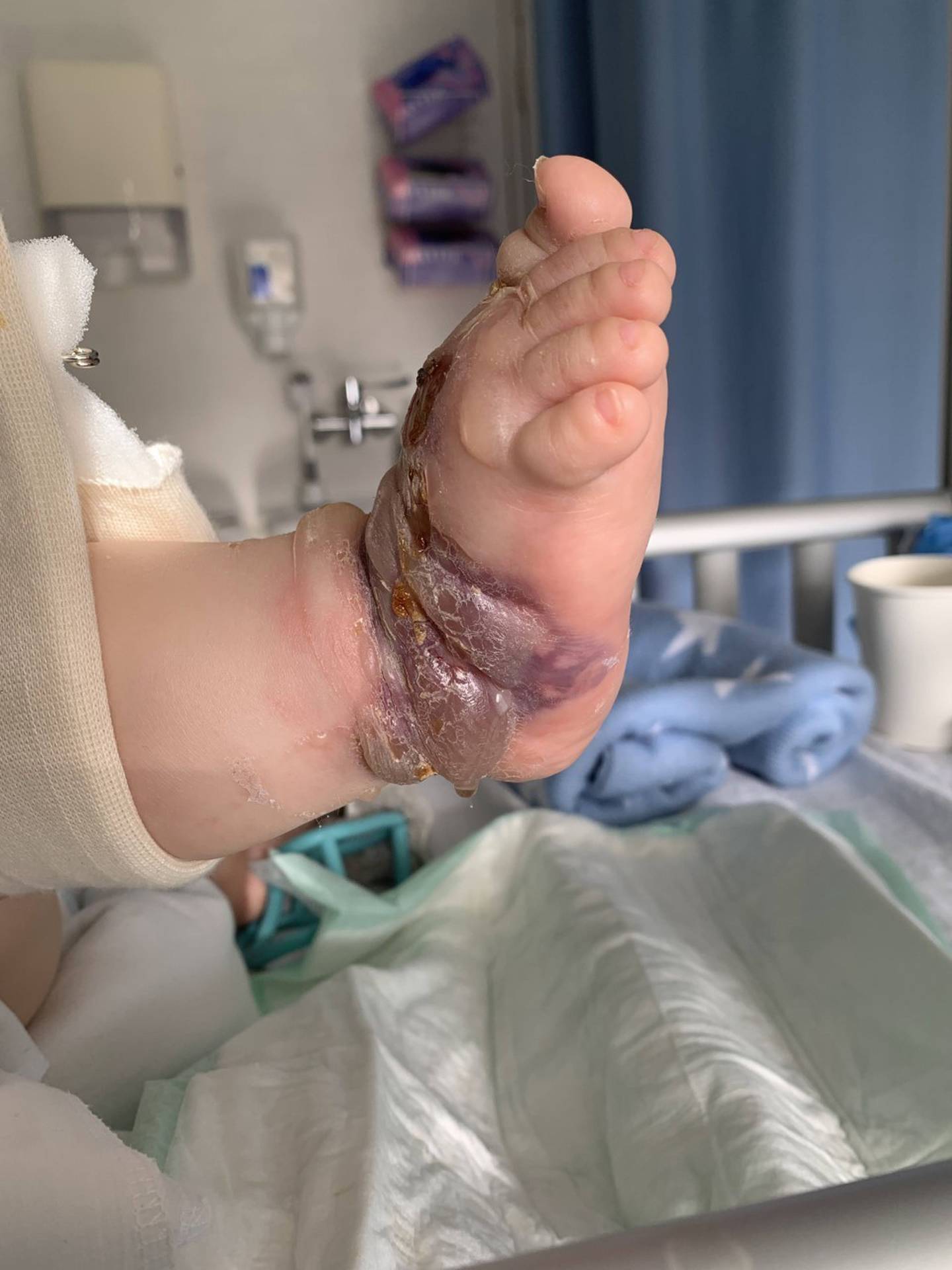 Lucas' foot a few days after it was discovered, prior to surgery. Photo: supplied