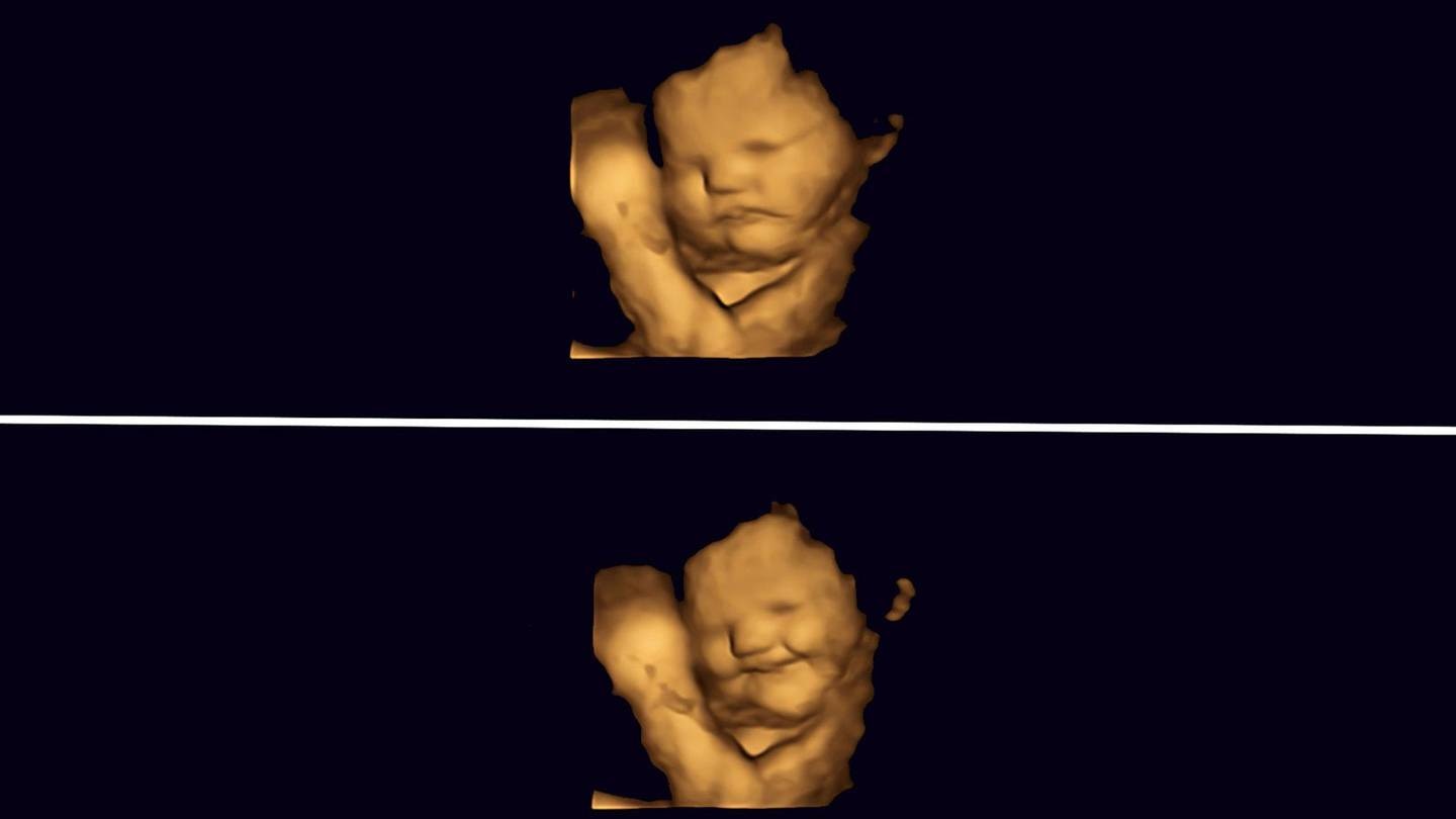 This 4D scan shows an unborn baby's neutral face (top) and a smiling face (bottom) after being...