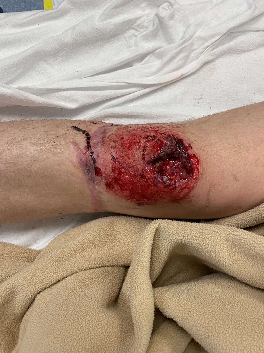Mac McCrostie has a deep wound to his knee after he fell off his bike in Lakeside Rd, near...