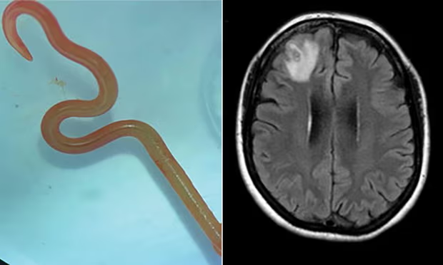 The Ophidascaris robertsi larvae specimen that was extracted alive from the woman’s brain by...