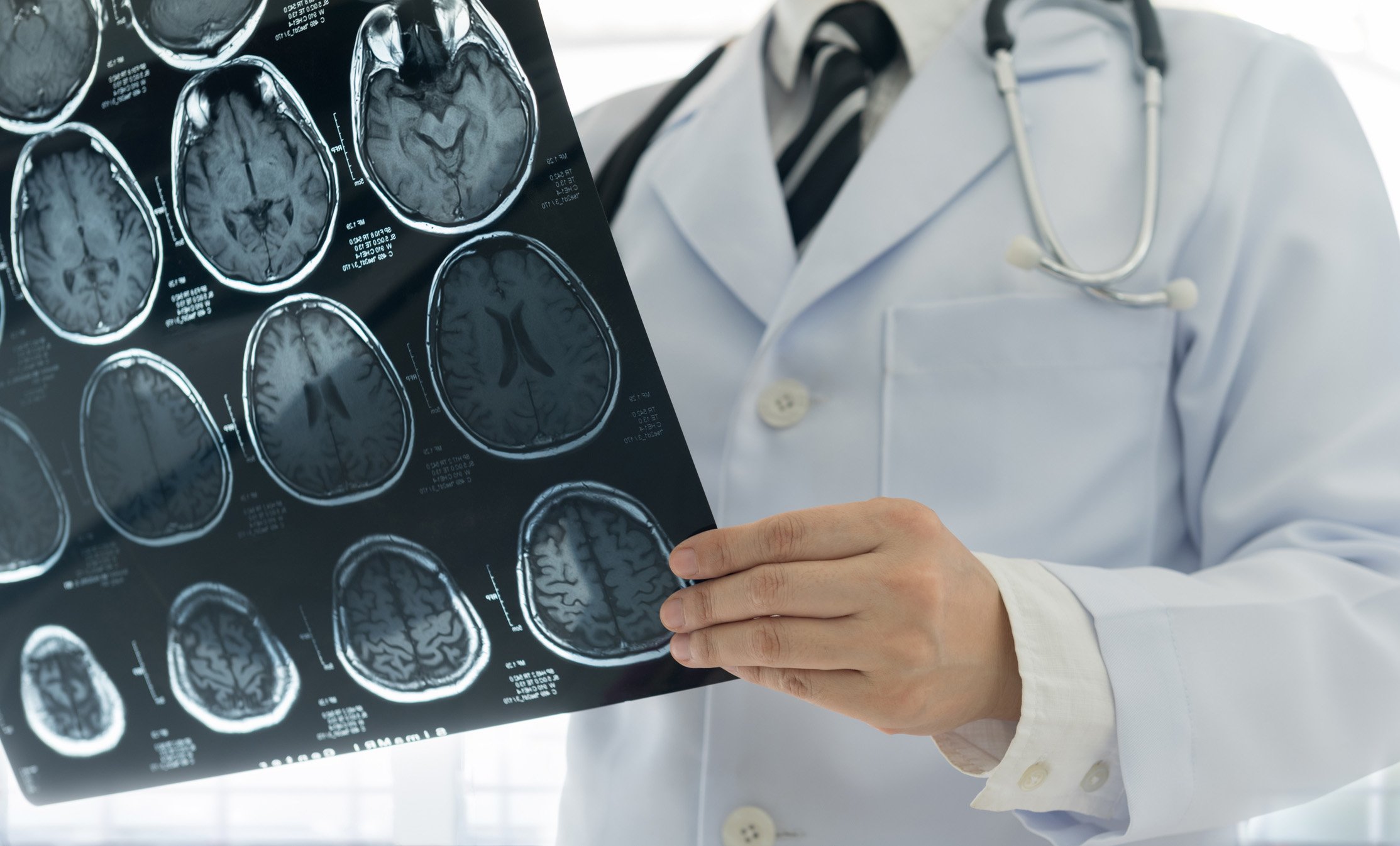 People experiencing stroke are on the rise. Photo: Getty Images