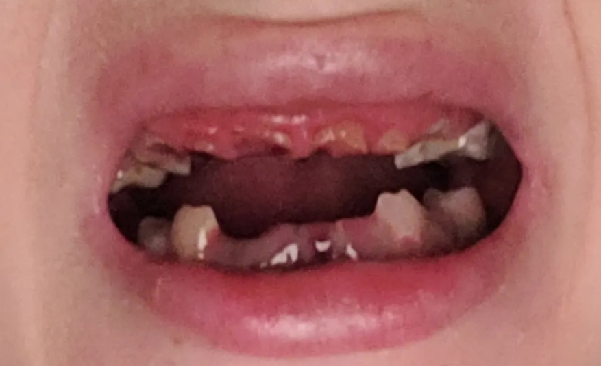 Ellie's ex-partner broke almost all of her teeth, and she cannot afford to get them fixed. Photo:...