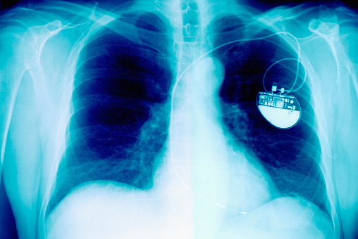 A pacemaker helps regulate the heart's natural rhythm. Photo: Getty Images 