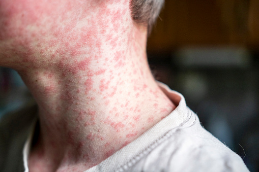 Measles is a highly infectious illness which affects people of all ages. Symptoms include a rash...