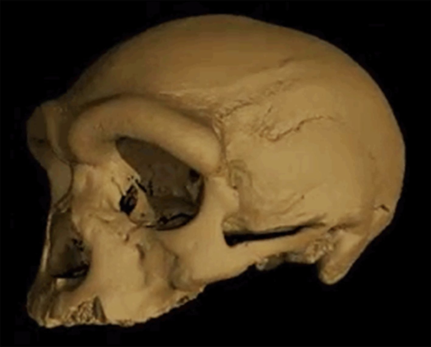The skull of "Dragon Man", Denisovan human remains found near Harbin, China, and revealed in 2018...