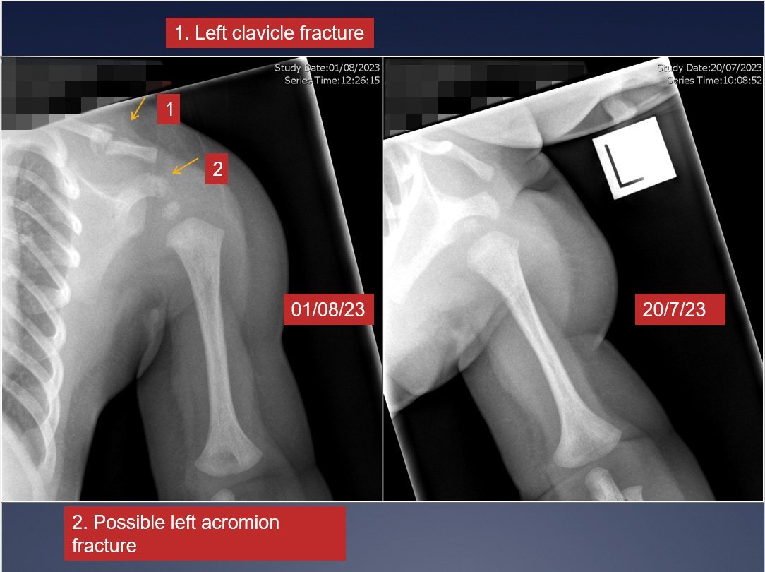 X-rays showing the broken collarbone. Photo: supplied