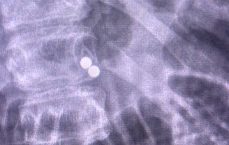 An X-ray showing magnets (File photo). Photo: Supplied