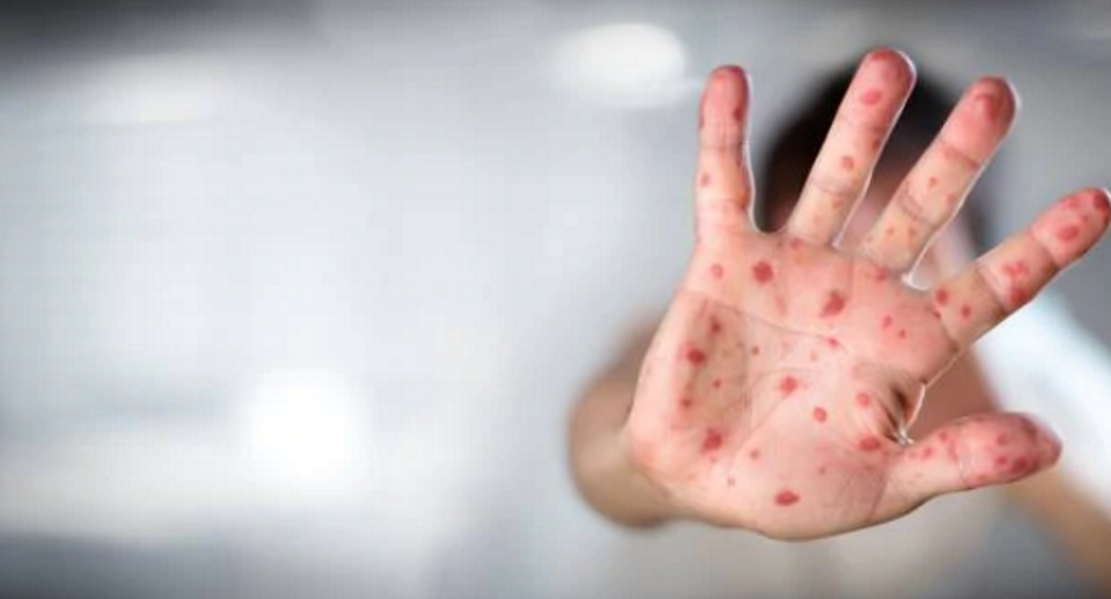 It can take up to two weeks before a person starts experiencing symptoms of measles. Photo: NZ...
