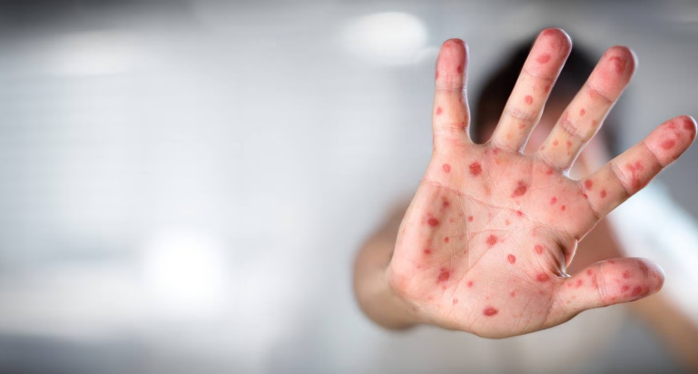 Measles is a very serious illness that spreads very quickly, much faster than Covid-19. Photo: NZ...