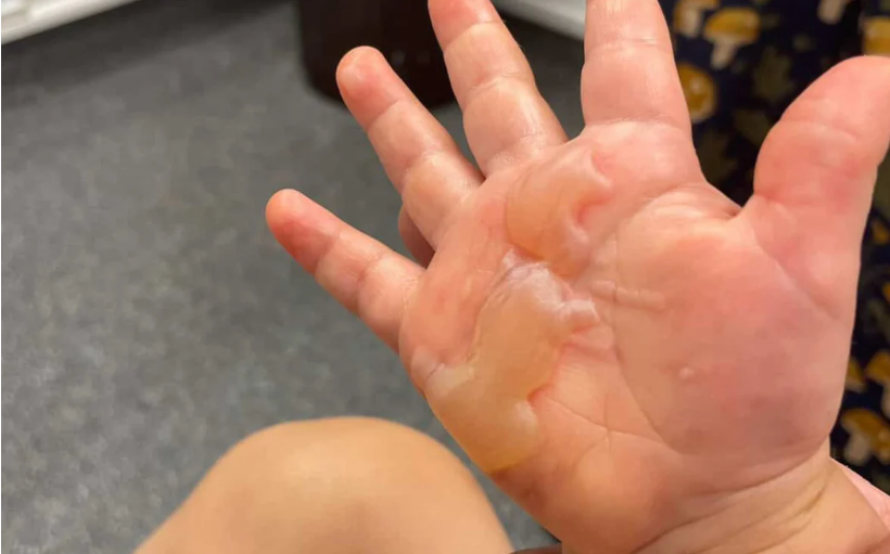 A young child's hand after being burnt on metal playground equipment. Photo: Supplied