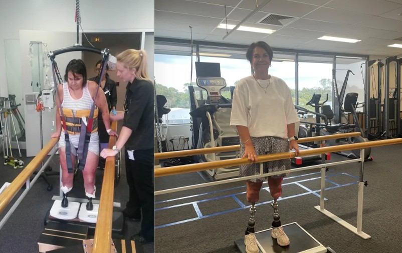 Penny Taylor after osteo-integration surgery in Australia. She's pushing for better aftercare for...