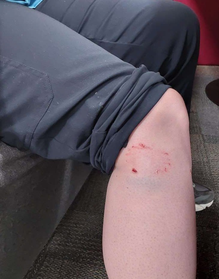 Bite marks on the victim's leg. 