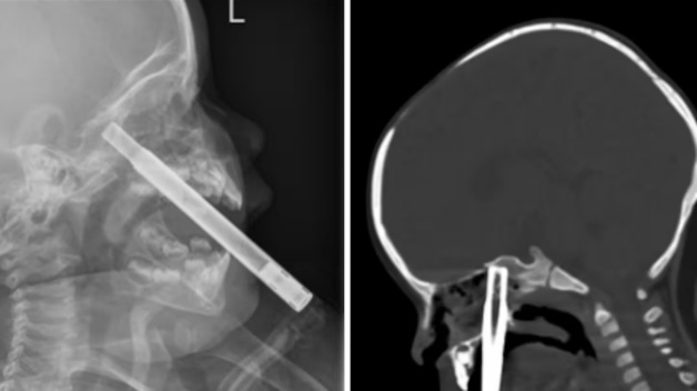 An X-ray of the child's head after a straw became embedded in her mouth. Photo / NZMJ