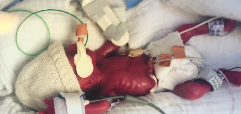 When Billie was born 25 weeks prematurely she weighed no more than a pound of butter. Photo: Supplied