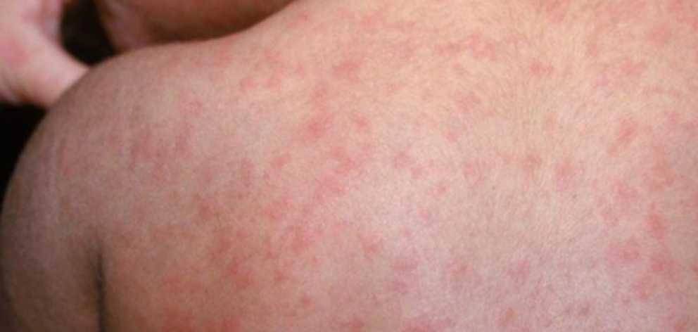 The Southern District Health Board said a Queenstown resident was confirmed to have had measles....