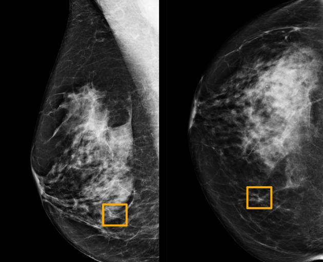 A yellow box indicates where an artificial intelligence system found cancer hiding inside breast...