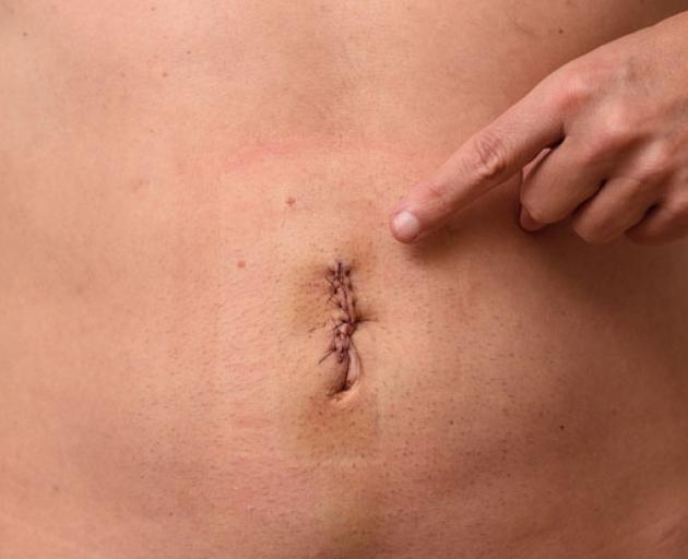 The woman's belly button had to be removed during complications in surgery. Photo: File image /...