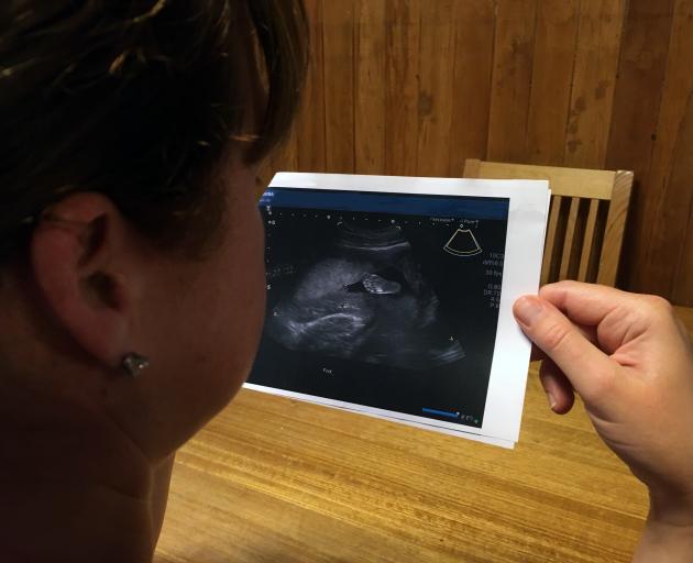 A Dunedin woman, who does not want to be identified, looks at an image of her baby’s foot from a...