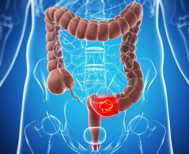 Cancers missed in the Waitemata pilot bowel screening programme have implications for the...