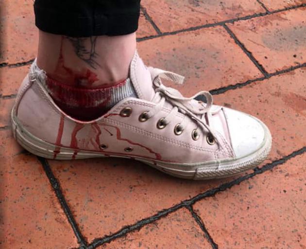 Jo Wilson's bloodied ankle after a Lime scooter mishap. Photo: Supplied