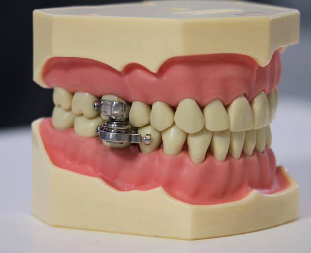 The dental device which stops users eating solid food by locking their mouths almost shut. PHOTO:...