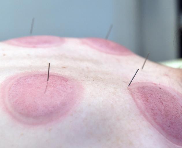 His freshly cupped back.