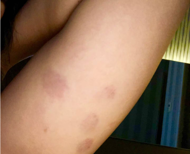 Bruises on Desta's arms after another alleged fight with Kelleher.