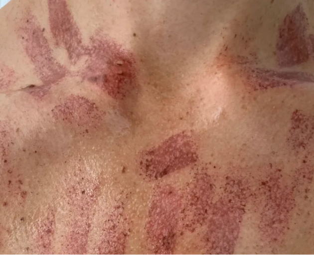 The woman was left with "checkerboard" burns across her chest. Photo: Supplied