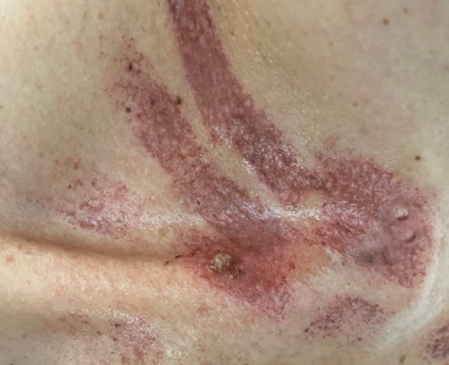 Moles on her chest were "specifically" targeted, experts say. Photo: Supplied