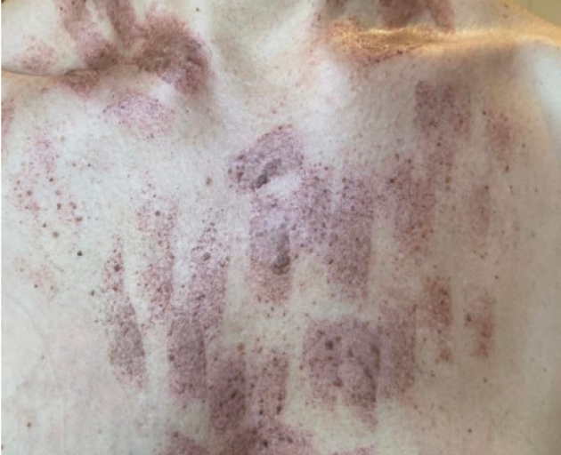 The woman says she was in pain for weeks following the treatment. Photo: Supplied
