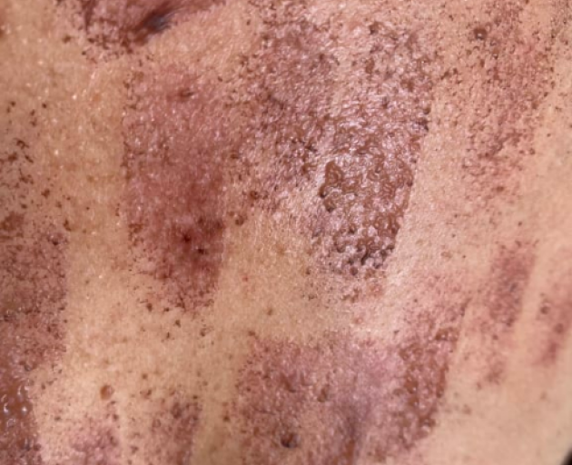 Experts say the burns are some of the worst they have ever seen. Photo: Supplied