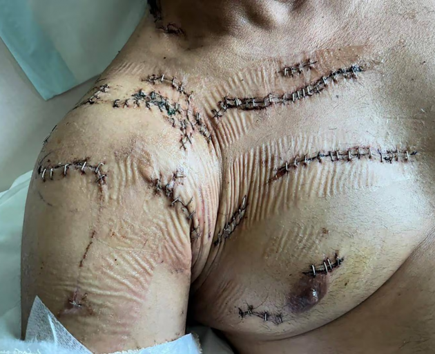 Radio host Harnek Singh required multiple surgeries after he was stabbed multiple times in the...