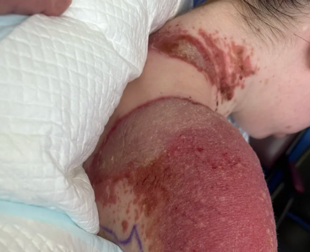 Charlotte's skin developed massive blisters like she had been cooked. She needed a feeding tube...
