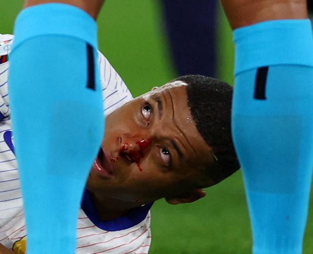 Kylian Mbappe reacts after sustaining his nose injury. Photo: Reuters