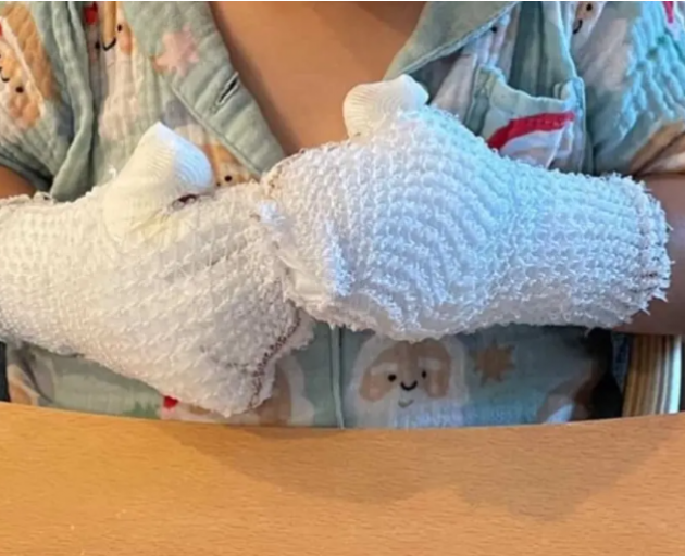 A child's hands bandaged after being burnt on playground equipment. Photo: Supplied