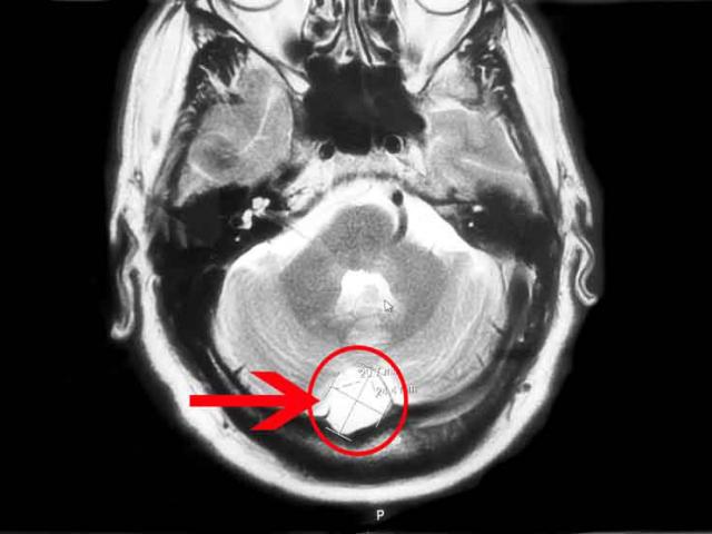 The scan showng the cyst in Kev Bonney's skull (circled). Photo: Dunedin Hospital
