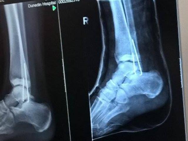 An X-ray of the compound fracture Emily Peacock (14) received when she was injured at Leap Indoor...